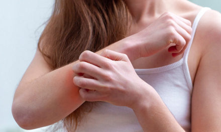 The Lowdown on Psoriasis: Signs, Symptoms and Treatments